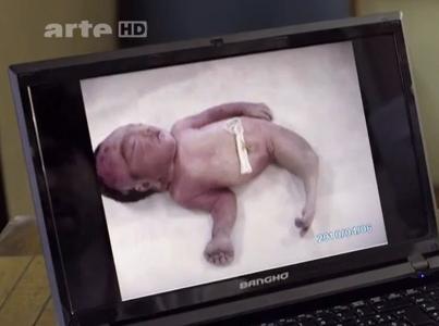 bébé sirène malformations glyphosate